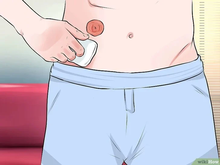 Keabsahan Salat Pengguna Kantong Stoma